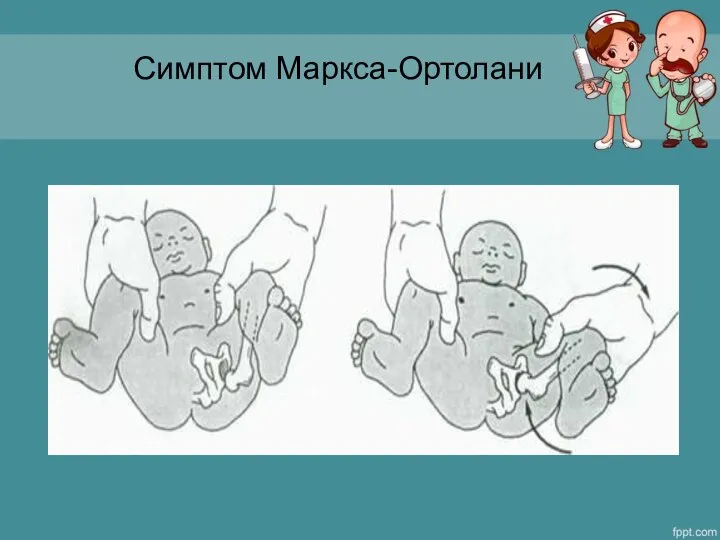 Симптом Маркса-Ортолани