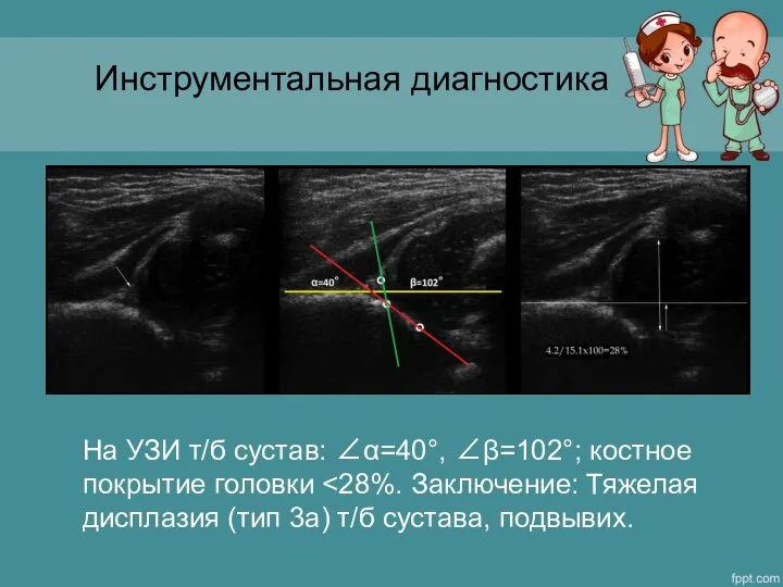 Инструментальная диагностика На УЗИ т/б сустав: ∠α=40°, ∠β=102°; костное покрытие головки