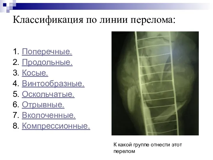 Классификация по линии перелома: 1. Поперечные. 2. Продольные. 3. Косые. 4.