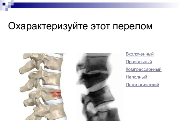 Охарактеризуйте этот перелом Вколоченный Продольный Компрессионный Неполный Патологический