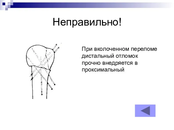 Неправильно! При вколоченном переломе дистальный отломок прочно внедряется в проксимальный