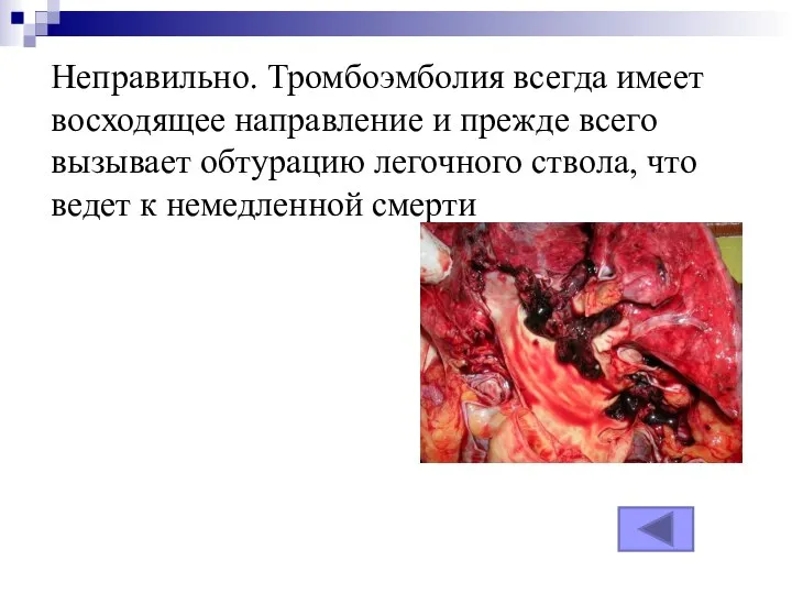 Неправильно. Тромбоэмболия всегда имеет восходящее направление и прежде всего вызывает обтурацию