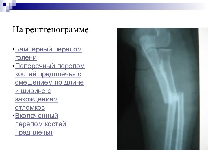 На рентгенограмме Бамперный перелом голени Поперечный перелом костей предплечья с смешением