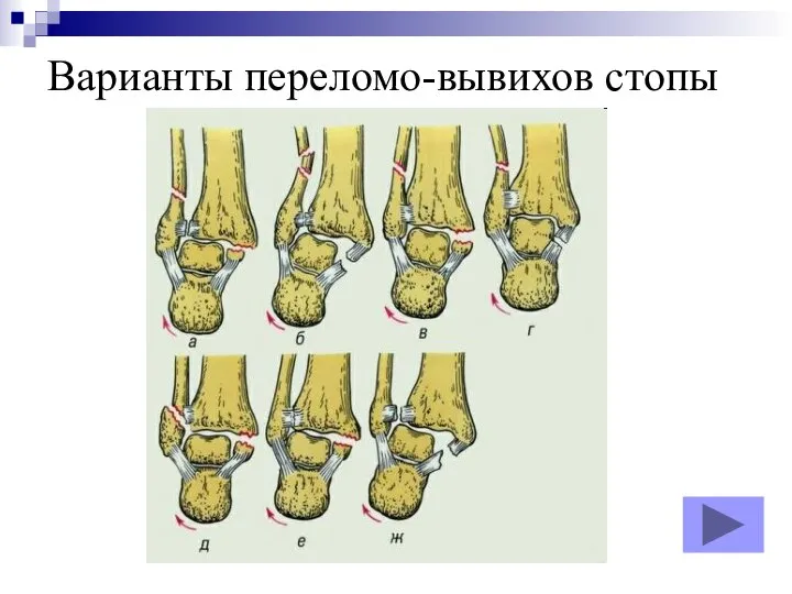 Варианты переломо-вывихов стопы