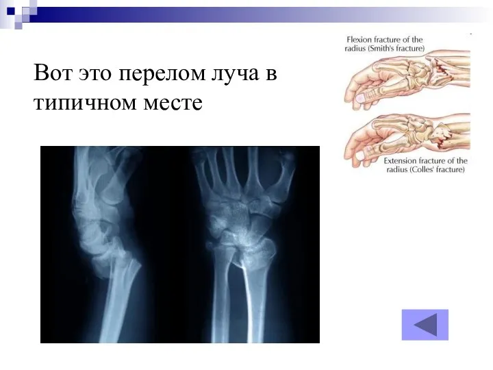 Вот это перелом луча в типичном месте