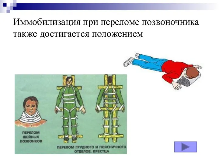 Иммобилизация при переломе позвоночника также достигается положением