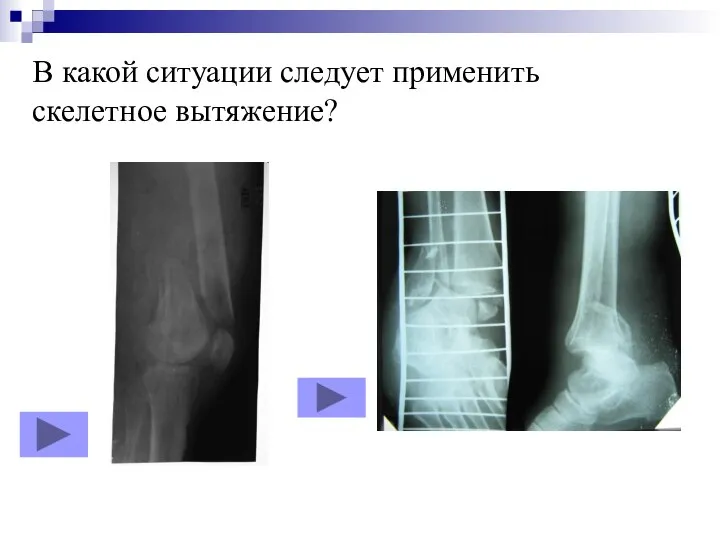 В какой ситуации следует применить скелетное вытяжение?