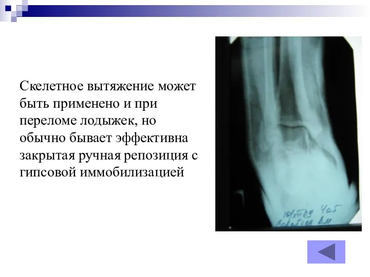 Скелетное вытяжение может быть применено и при переломе лодыжек, но обычно