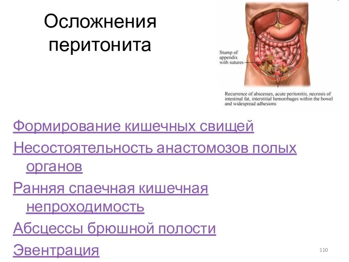 Осложнения перитонита Формирование кишечных свищей Несостоятельность анастомозов полых органов Ранняя спаечная