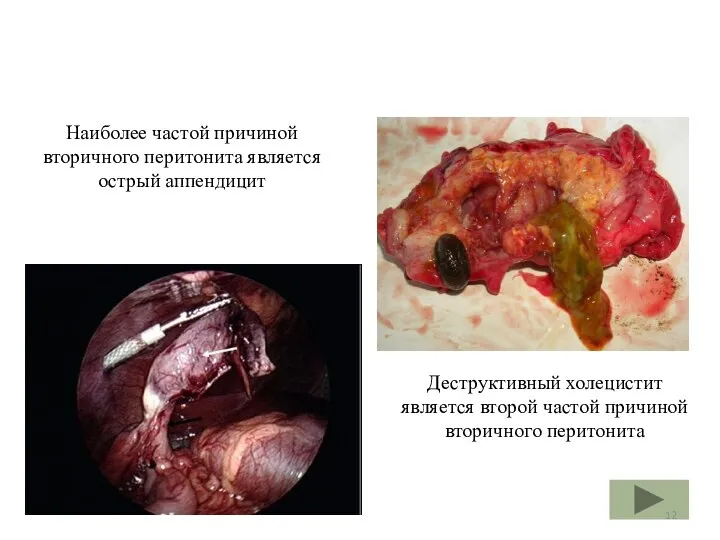 Деструктивный холецистит является второй частой причиной вторичного перитонита Наиболее частой причиной вторичного перитонита является острый аппендицит