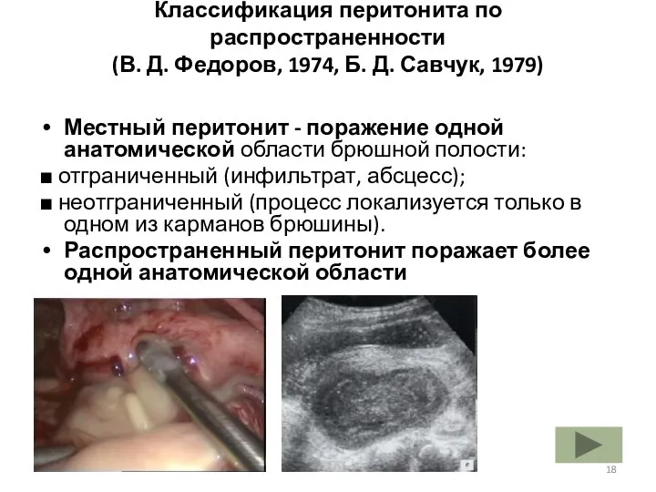 Классификация перитонита по распространенности (В. Д. Федоров, 1974, Б. Д. Савчук,