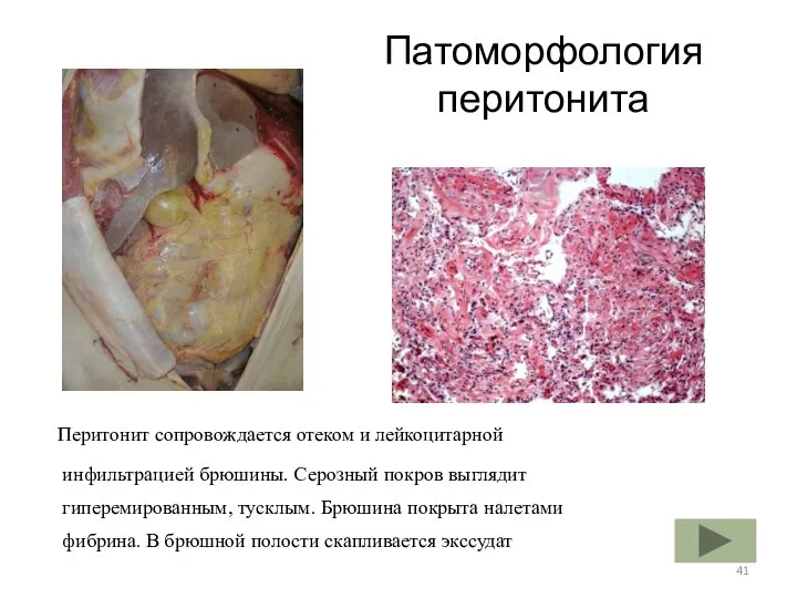 Патоморфология перитонита Перитонит сопровождается отеком и лейкоцитарной инфильтрацией брюшины. Серозный покров