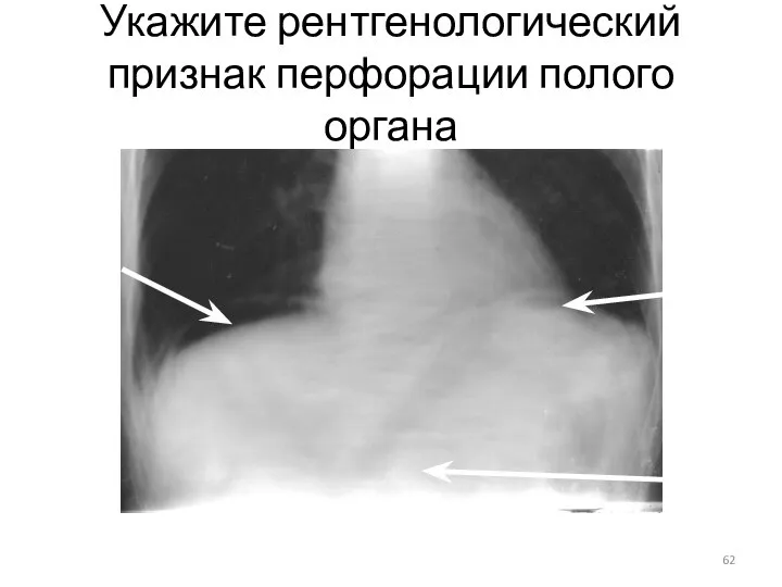 Укажите рентгенологический признак перфорации полого органа