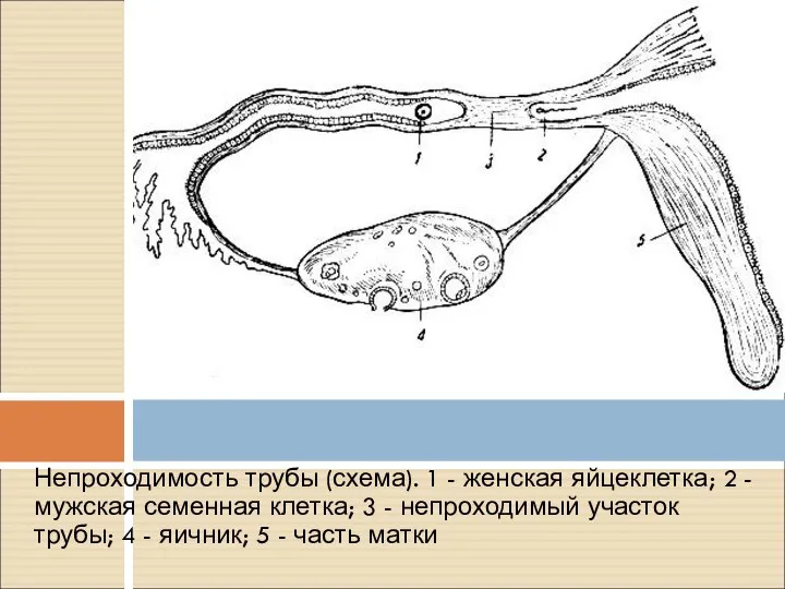 Непроходимость трубы (схема). 1 - женская яйцеклетка; 2 - мужская семенная