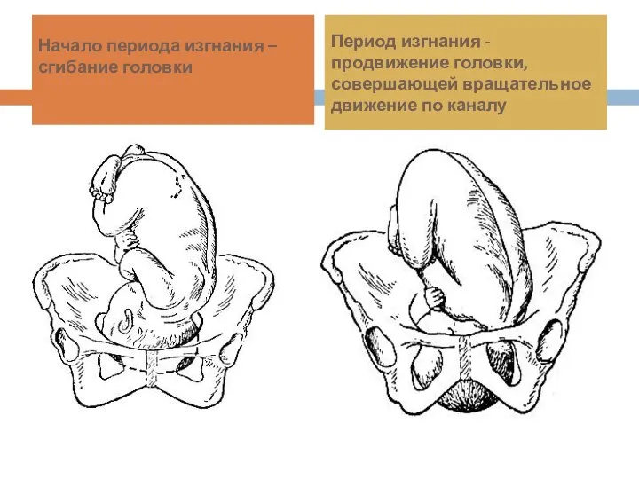 Начало периода изгнания – сгибание головки Период изгнания - продвижение головки, совершающей вращательное движение по каналу