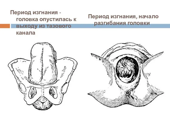 Период изгнания - головка опустилась к выходу из тазового канала Период изгнания, начало разгибания головки