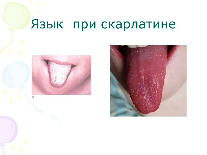 Язык при скарлатине