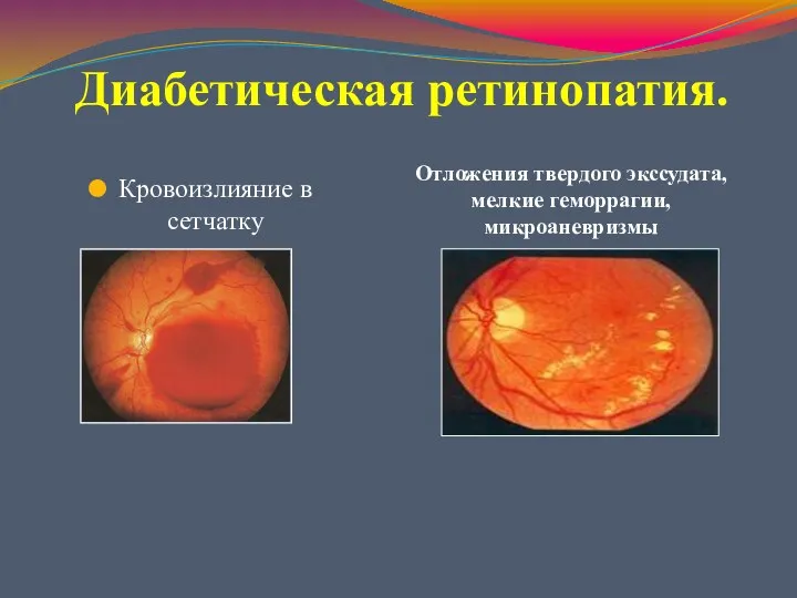 Диабетическая ретинопатия. Кровоизлияние в сетчатку Отложения твердого экссудата, мелкие геморрагии, микроаневризмы