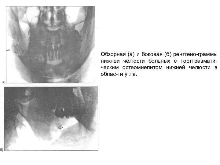 Обзорная (а) и боковая (б) рентгено-граммы нижней челюсти больных с посттравмати-ческим