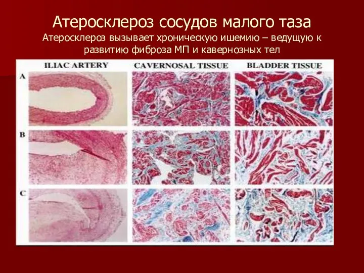 Атеросклероз сосудов малого таза Атеросклероз вызывает хроническую ишемию – ведущую к