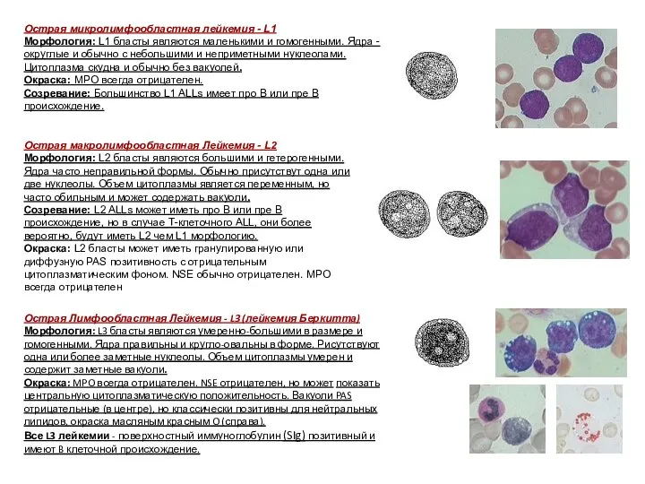 . Острая Лимфообластная Лейкемия - L3 (лейкемия Беркитта) Морфология: L3 бласты