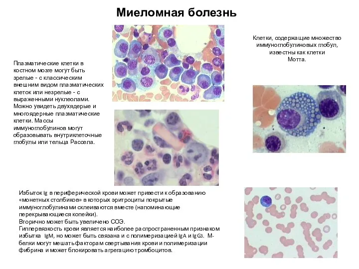 Миеломная болезнь Клетки, содержащие множество иммуноглобулиновых глобул,известны как клетки Мотта. Избыток