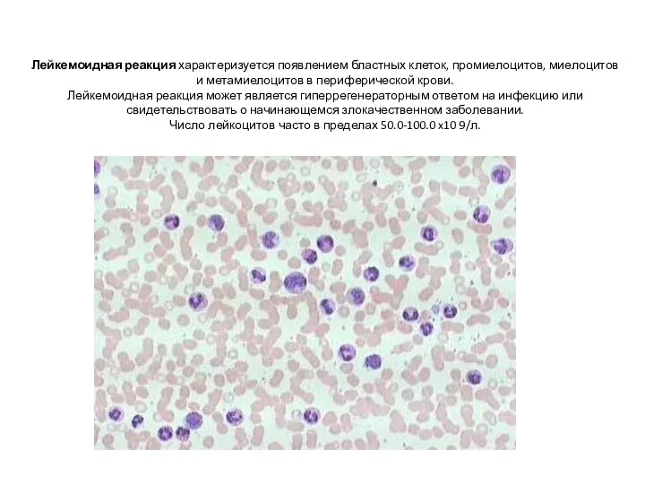Лейкемоидная реакция характеризуется появлением бластных клеток, промиелоцитов, миелоцитов и метамиелоцитов в