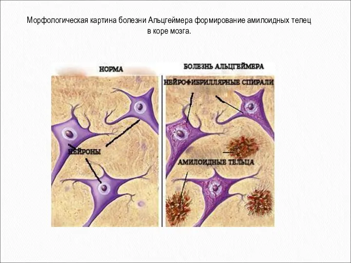Морфологическая картина болезни Альцгеймера формирование амилоидных телец в коре мозга.