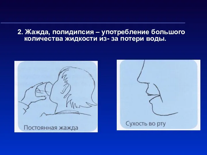 2. Жажда, полидипсия – употребление большого количества жидкости из- за потери воды.