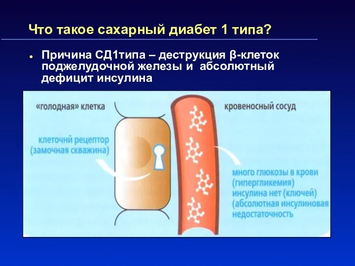 Что такое сахарный диабет 1 типа? Причина СД1типа – деструкция β-клеток