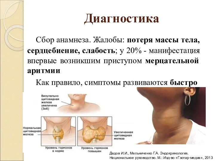 Диагностика Сбор анамнеза. Жалобы: потеря массы тела, сердцебиение, слабость; у 20%