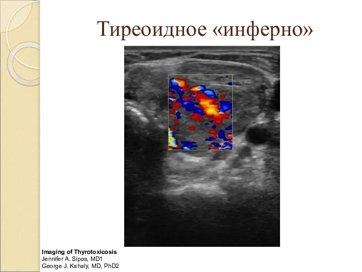 Тиреоидное «инферно» Imaging of Thyrotoxicosis Jennifer A. Sipos, MD1 George J. Kahaly, MD, PhD2