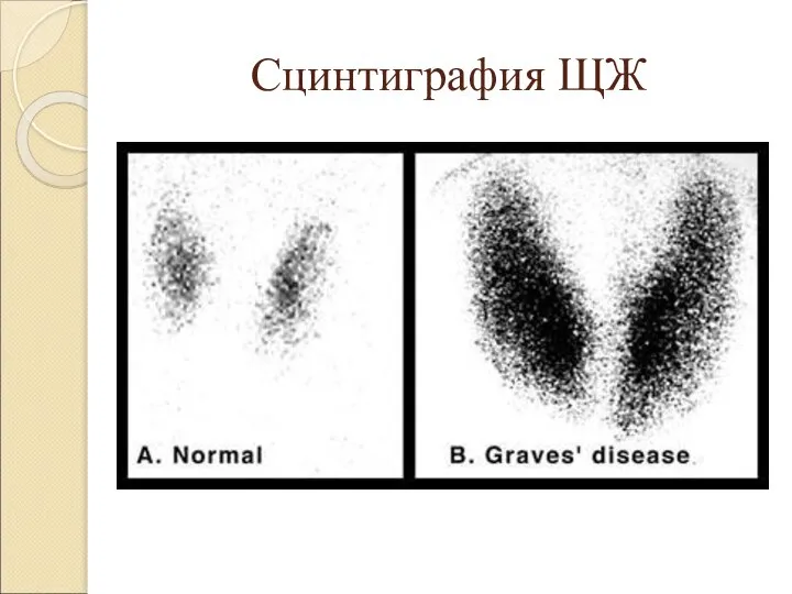 Сцинтиграфия ЩЖ