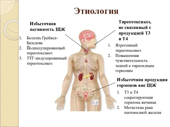 Этиология Избыточная активность ЩЖ Избыточная продукция гормонов вне ЩЖ Тиреотоксикоз, не