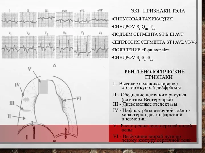 РЕНТГЕНОЛОГИЧЕСКИЕ ПРИЗНАКИ I - Высокое и малоподвижное стояние купола диафрагмы II