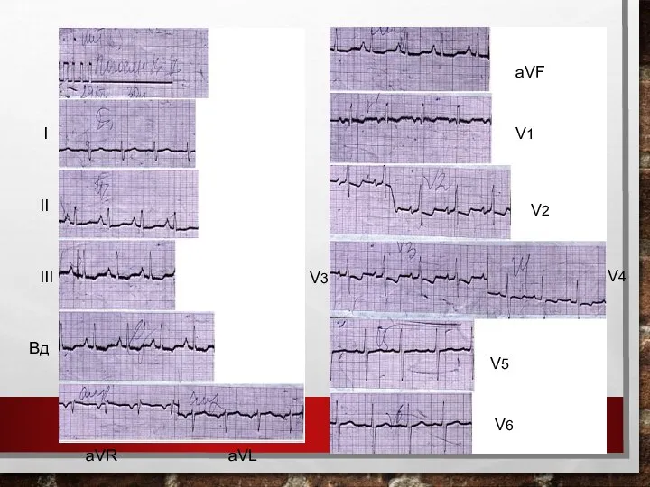 I II III Вд aVR aVL aVF V1 V2 V3 V6 V4 V5