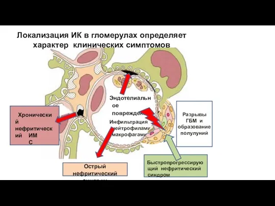 Эндотелиальное повреждение Инфильтрация нейтрофилами макрофагами Острый нефритический синдром Хронический нефритический ИМС