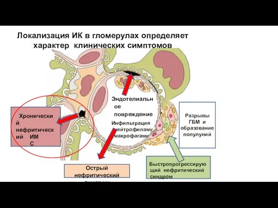 Эндотелиальное повреждение Инфильтрация нейтрофилами макрофагами Острый нефритический синдром Хронический нефритический ИМС