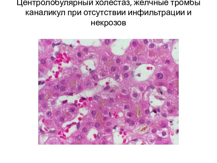 Центролобулярный холестаз, жёлчные тромбы каналикул при отсутствии инфильтрации и некрозов