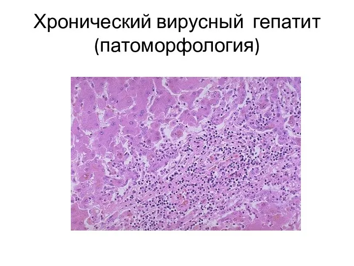 Хронический вирусный гепатит (патоморфология)