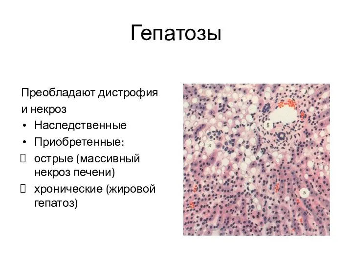 Гепатозы Преобладают дистрофия и некроз Наследственные Приобретенные: острые (массивный некроз печени) хронические (жировой гепатоз)