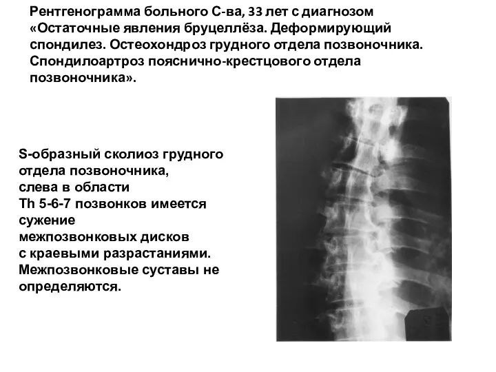 Рентгенограмма больного С-ва, 33 лет с диагнозом «Остаточные явления бруцеллёза. Деформирующий