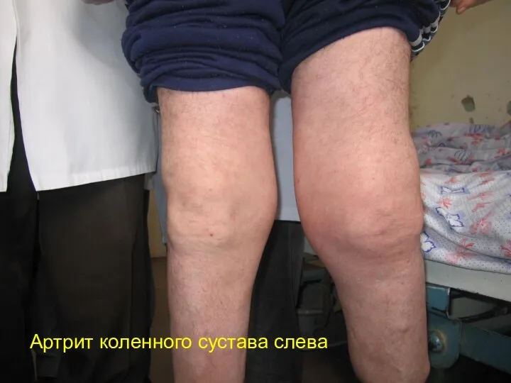 Артрит коленного сустава слева