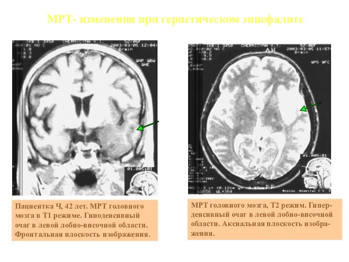 Пациентка Ч, 42 лет. МРТ головного мозга в Т1 режиме. Гиподенсивный