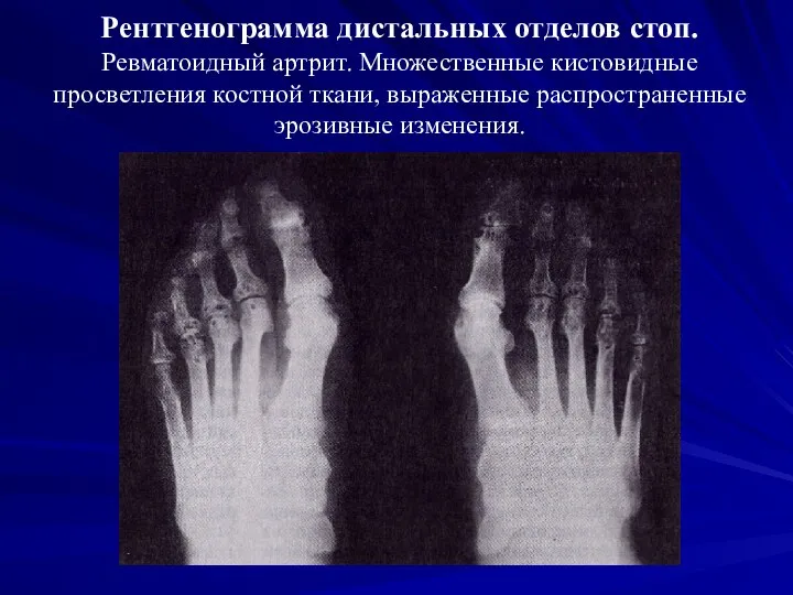 Рентгенограмма дистальных отделов стоп. Ревматоидный артрит. Множественные кистовидные просветления костной ткани, выраженные распространенные эрозивные изменения.