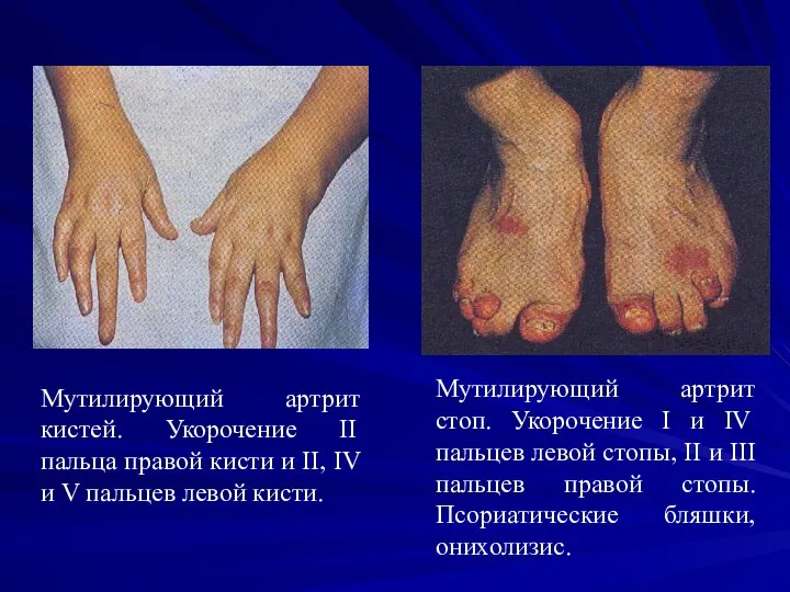 Мутилирующий артрит кистей. Укорочение II пальца правой кисти и II, IV