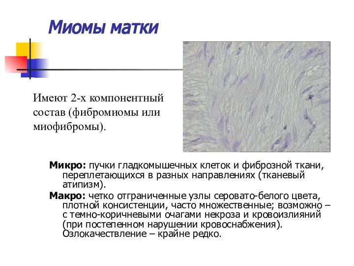 Миомы матки Микро: пучки гладкомышечных клеток и фиброзной ткани, переплетающихся в