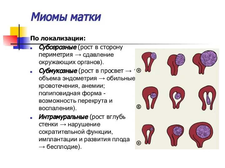 Миомы матки По локализации: Субсерозные (рост в сторону периметрия → сдавление