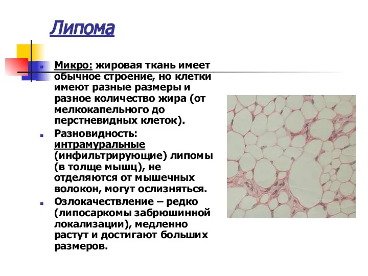 Липома Микро: жировая ткань имеет обычное строение, но клетки имеют разные