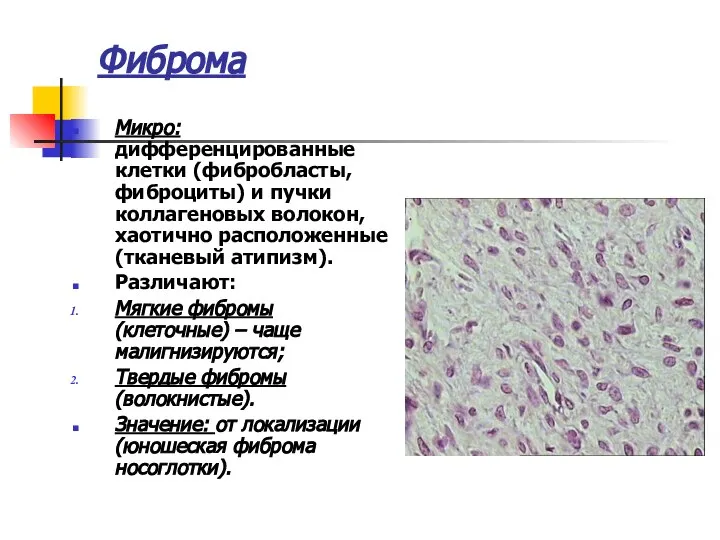 Фиброма Микро: дифференцированные клетки (фибробласты, фиброциты) и пучки коллагеновых волокон, хаотично